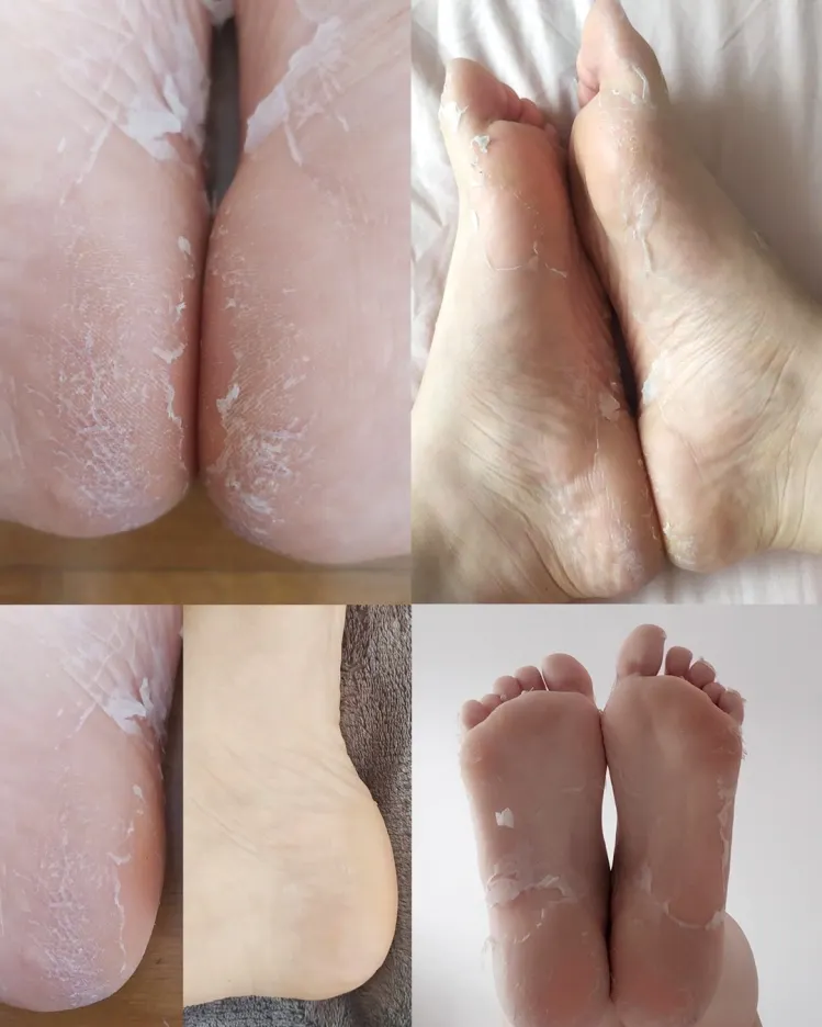 Ексфолираща маска за крака Iroha Peeling & Exfoliating Socks Mask for Feet — 7