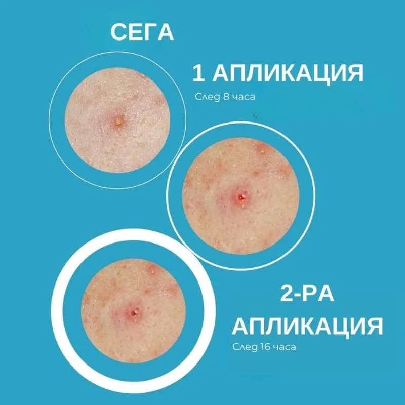 SOS Лепенки за пъпки със салицилова киселина Iroha SOS Pimple Patches with Salicylic Acid — 2