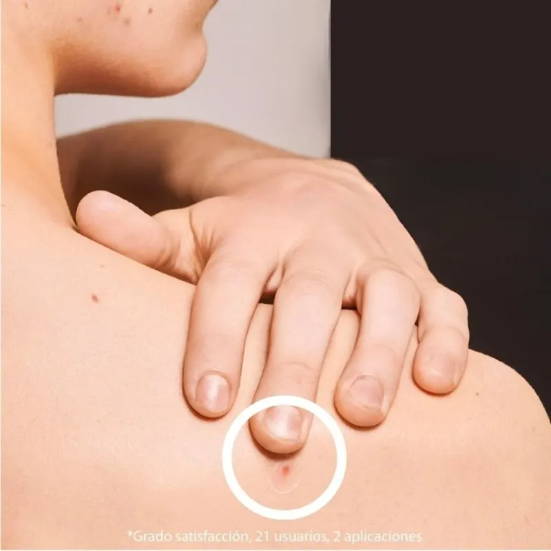 SOS Лепенки за пъпки със салицилова киселина Iroha SOS Pimple Patches with Salicylic Acid — 3