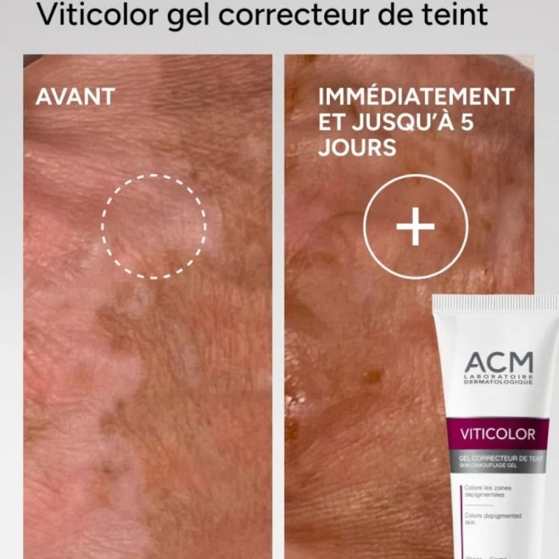 Камуфлажен гел за витилиго и депигментирани зони с DHA и Erythrulose ACM Viticolor Complexion Correcting Gel 50 ml — 4